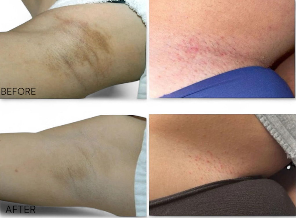 Whitening Cream Private Parts Underarm Bleaching Whiten Butt Knee Brighten Inner Thigh Intimate Parts Dark Remove Melanin Care